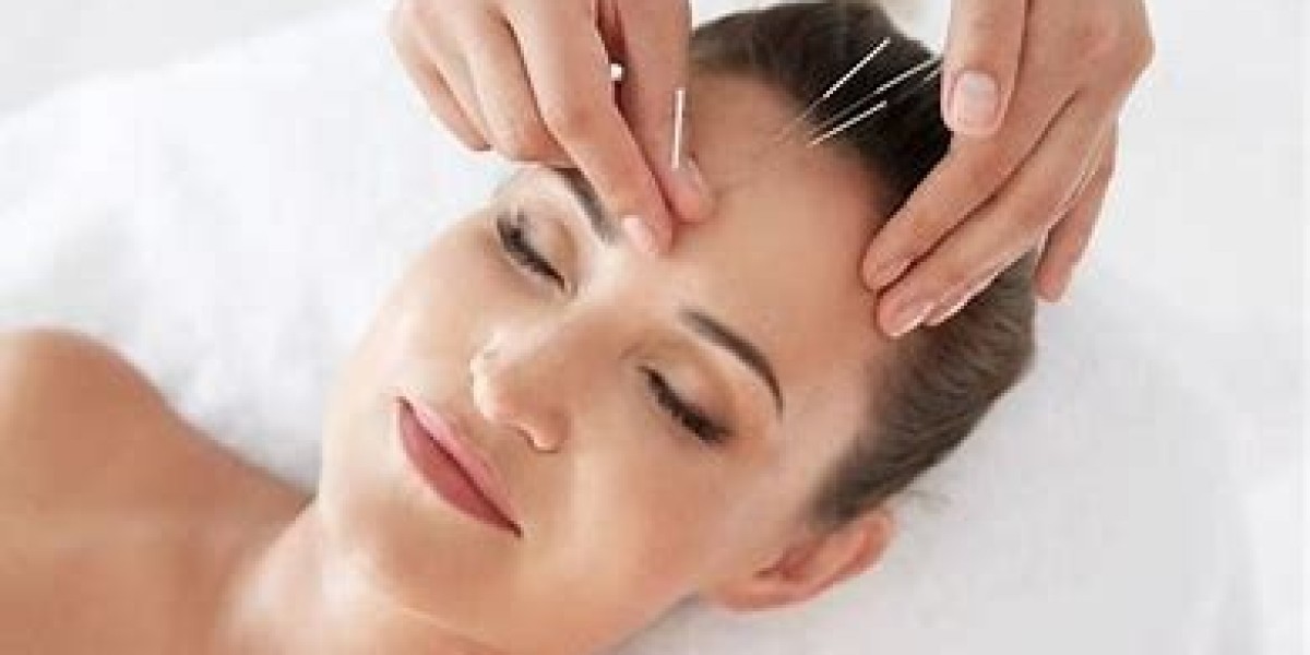 Best Acupuncture Specialists in Redmond – Top-Rated Experts for Pain Relief & Wellness