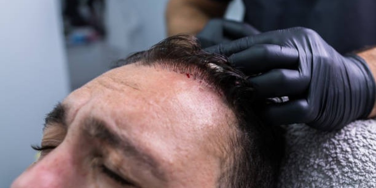 PRP Hair Treatment in Islamabad: Regenerating Hair from the Roots