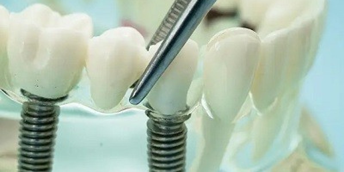Dental Implants and Oral Hygiene Tips
