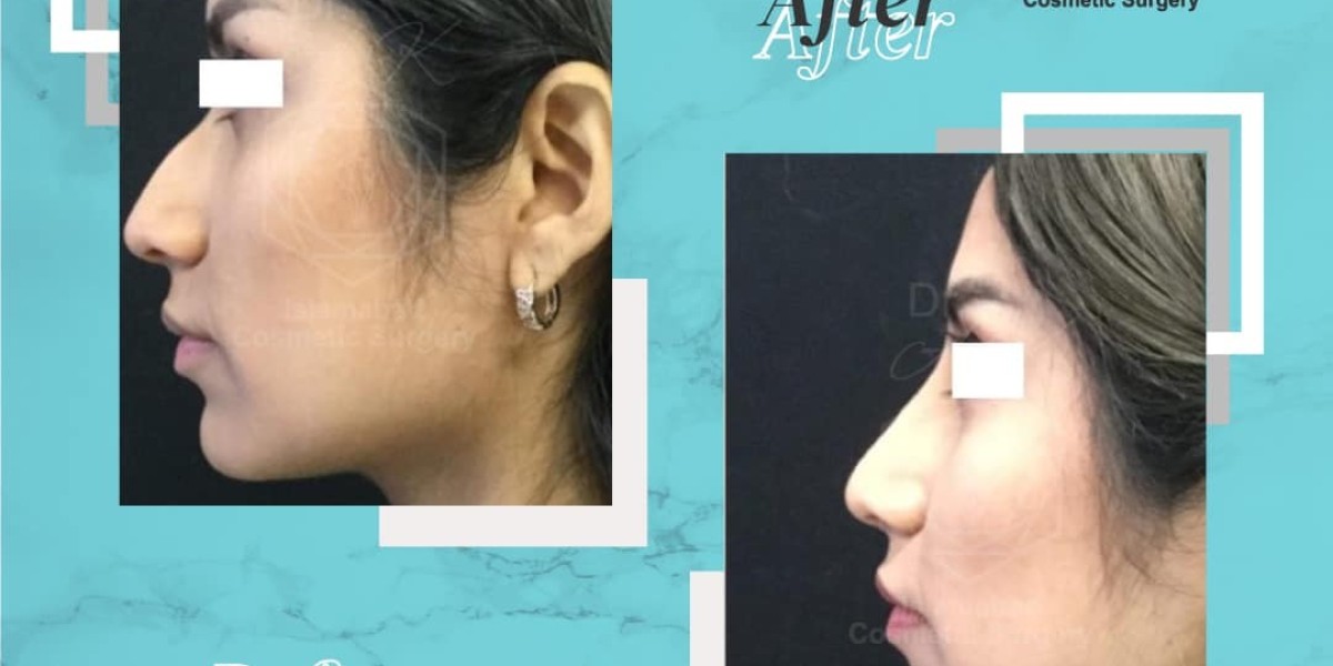 Everything You Need to Know About Rhinoplasty in Pakistan