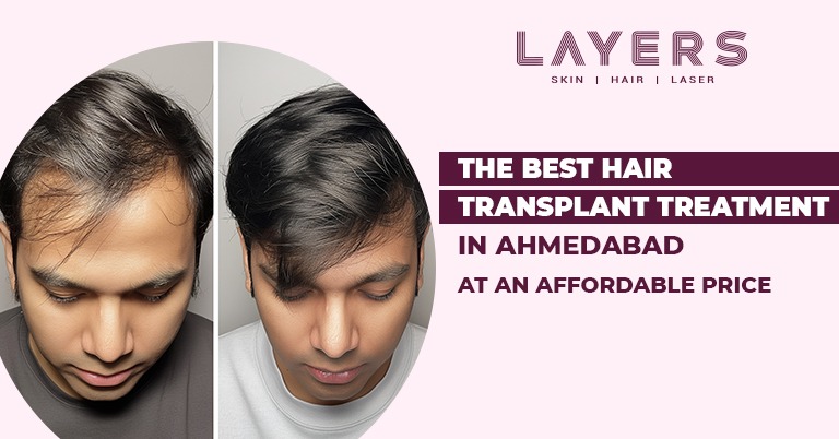 Best Hair Transplant in Ahmedabad - Layers Clinics