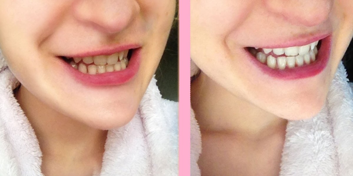 Are Veneers in Dubai Painful? What to Expect