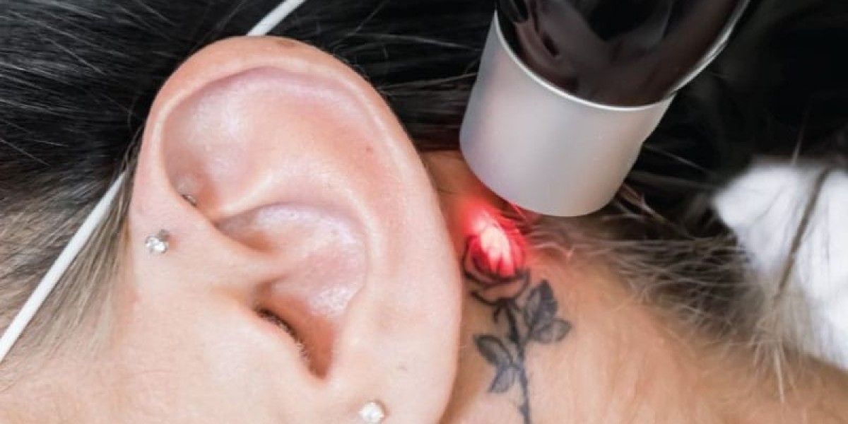 Picosure Tattoo Removal: Does It Leave Scars?