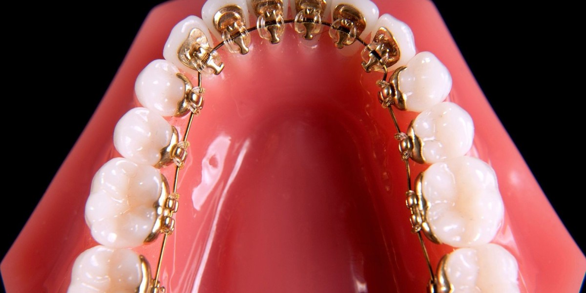 Dental Braces in Dubai: Modern Solutions Guide
