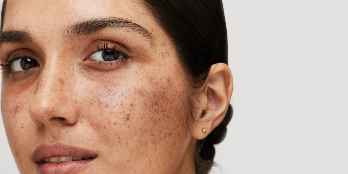 Can Melasma Treatment Permanently Remove Pigmentation?