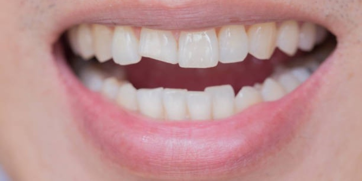 Advanced Dental Solutions for Tooth Fracture Treatment in Islamabad