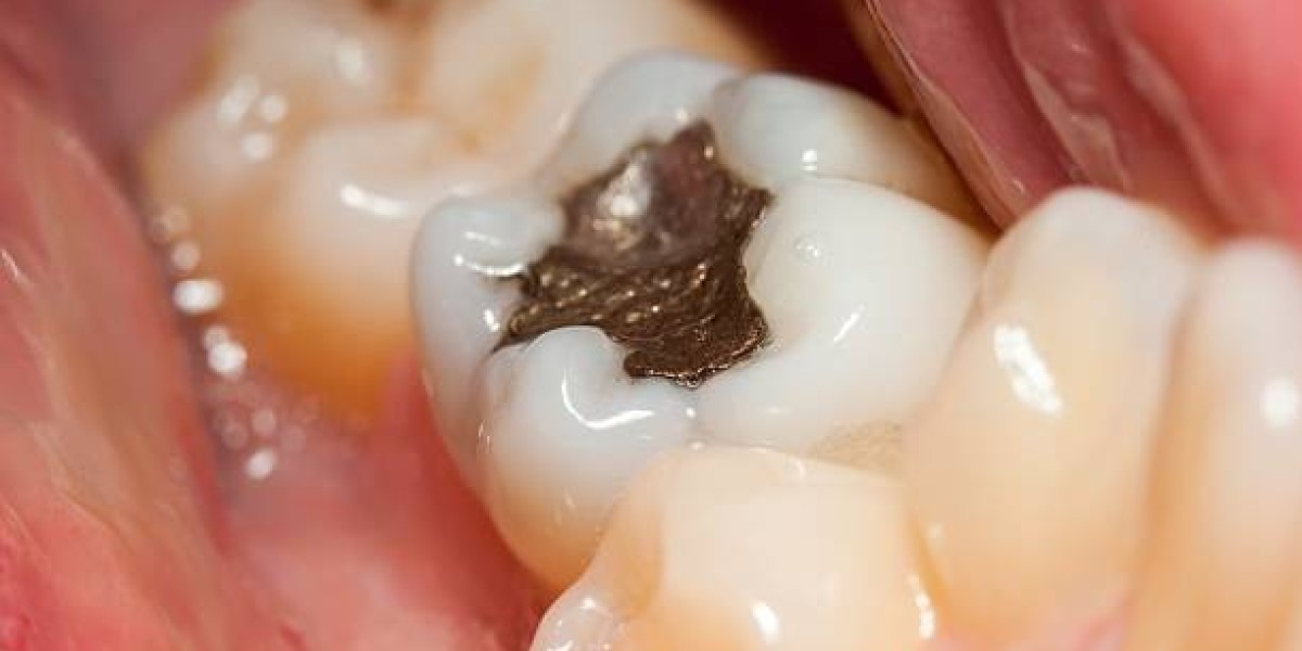 Dental Filling in Pakistan – Restore Tooth Strength with Modern Dentistry