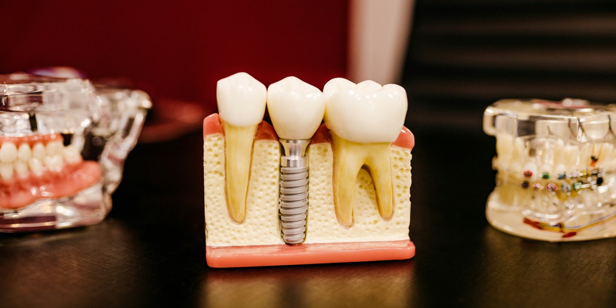 7 Benefits of Dental Implants for Tooth Replacement