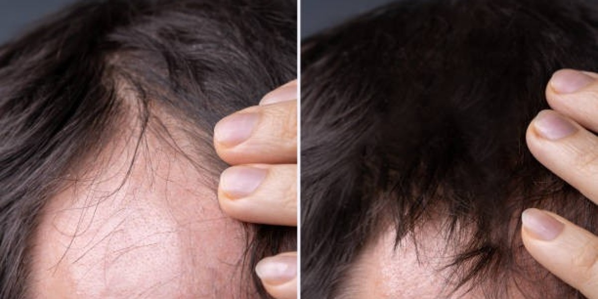 Complete Guide to Modern Hair Regrowth and Advanced Restoration Techniques
