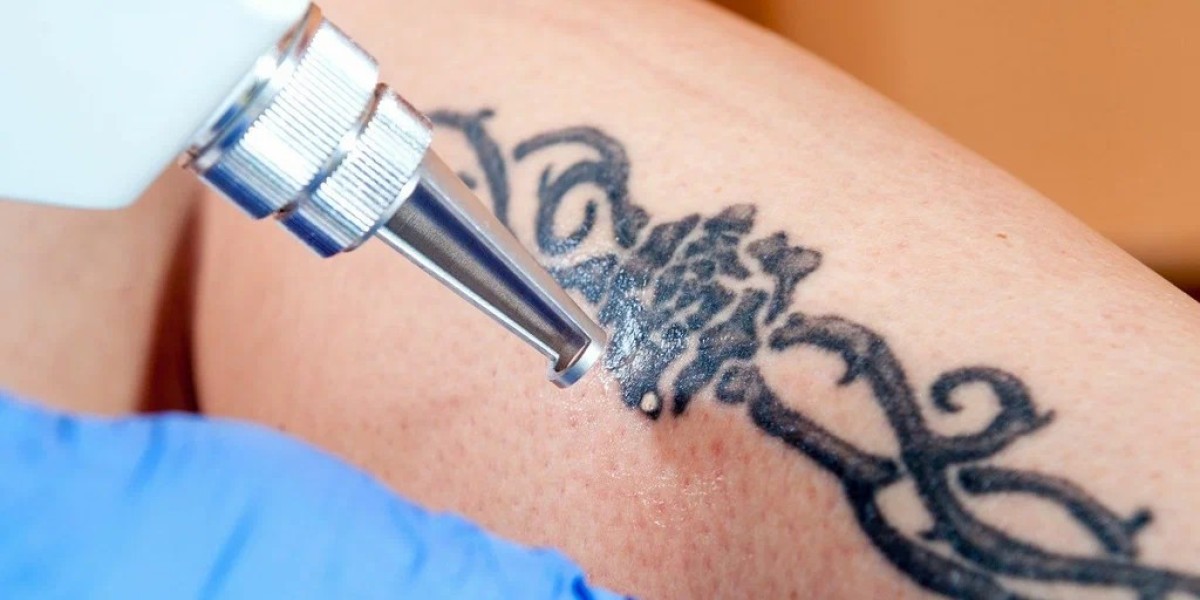 Laser Tattoo Removal Brings Fresh Skin Confidence To Life