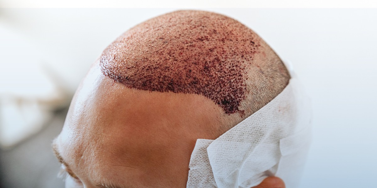 Hair Transplant In Dubai: Permanent Hair Restoration with Natural Results