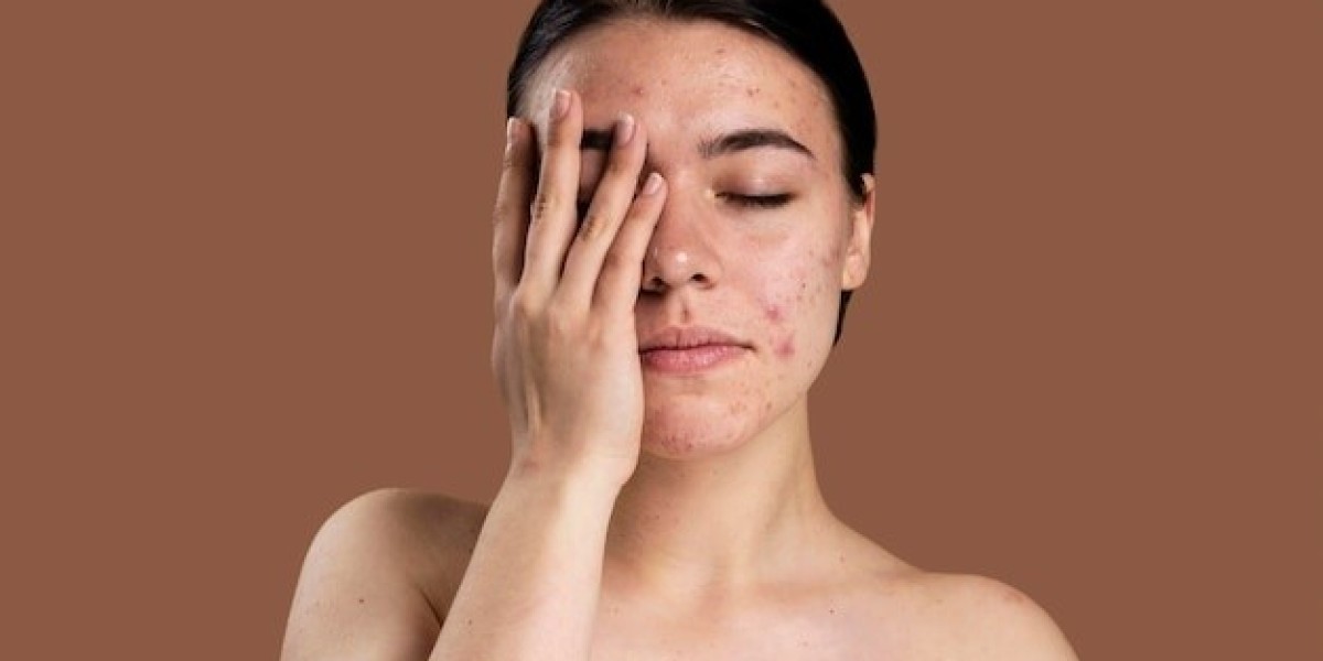 Acne - Mid Florida Dermatology and Plastic Surgery