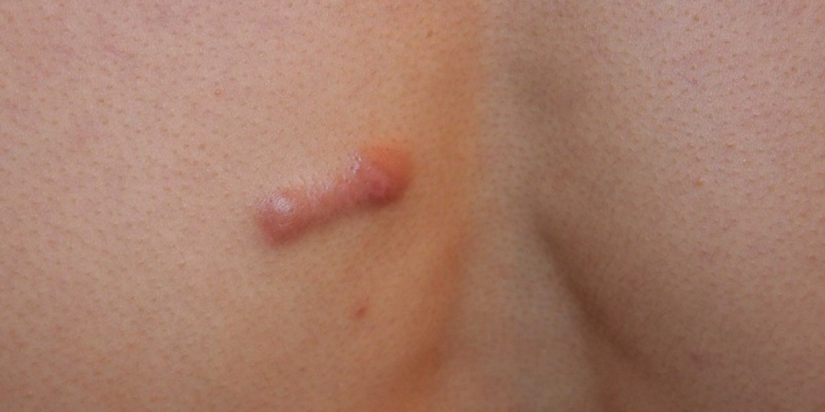 Keloid Treatment Helping Achieve Smooth and Attractive Skin