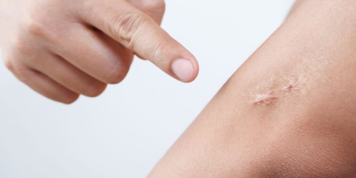 Keloid Treatment for Enhanced Skin Clarity and Smooth Texture
