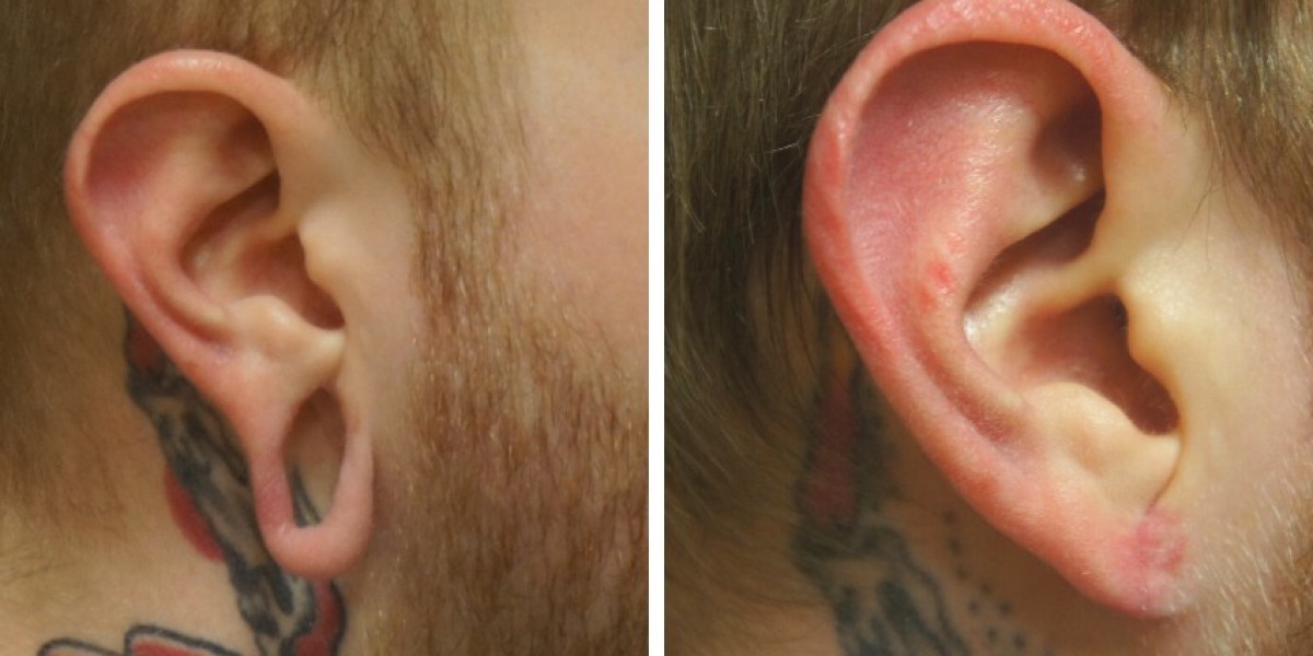 Earlobe Correction and Its Role in Ear Rejuvenation