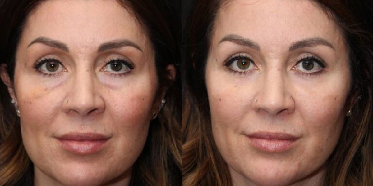 Lower Blepharoplasty Recovery: Tips for a Smooth Healing Process