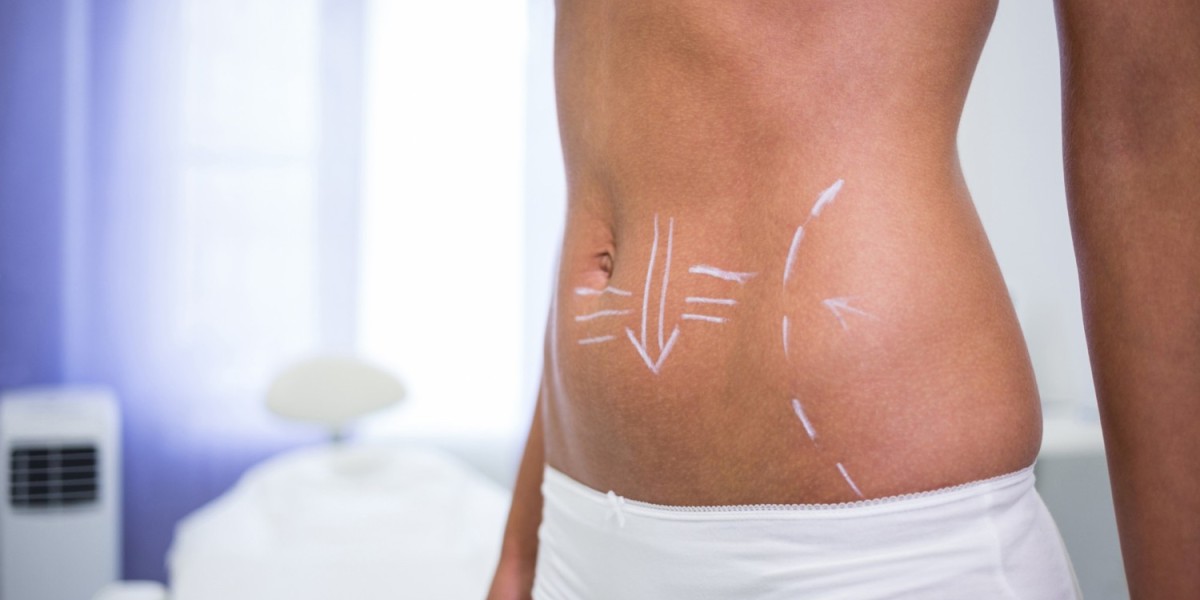 Tummy Tuck Dubai: Recovery Timeline Explained
