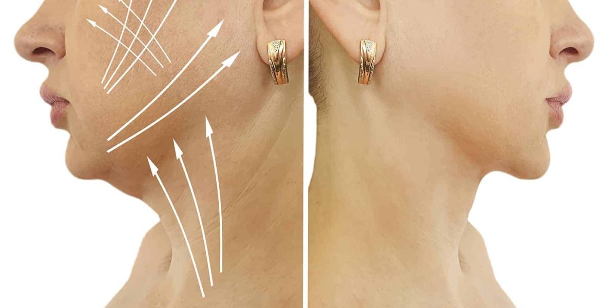 Double Chin Removal in Dubai From Consultation to Results
