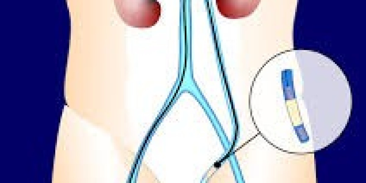 Understanding Varicose Veins Treatment and Modern Care Options